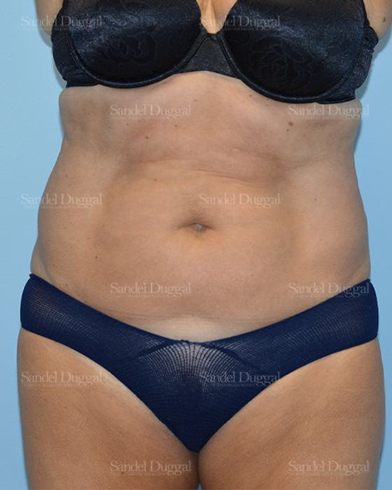 Tummy Tuck before, case 1636