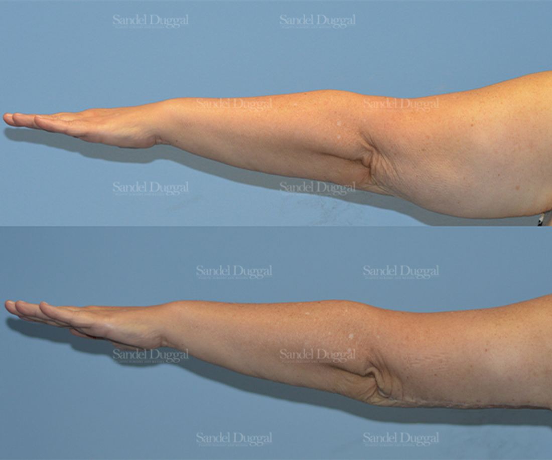 Brachioplasty before and after, case 2108