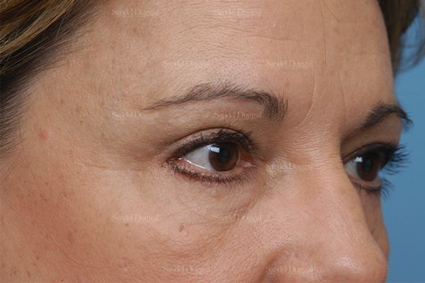 Eyelid Rejuvenation after, case 1900