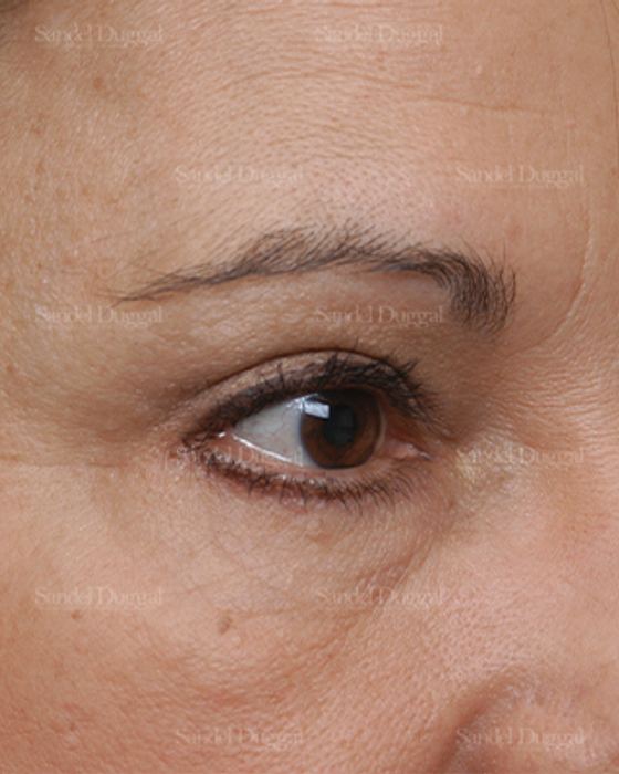 Eyelid Rejuvenation after, case 1900