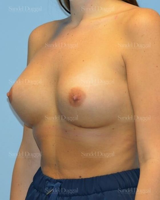 Breast Augmentation after, case 4756