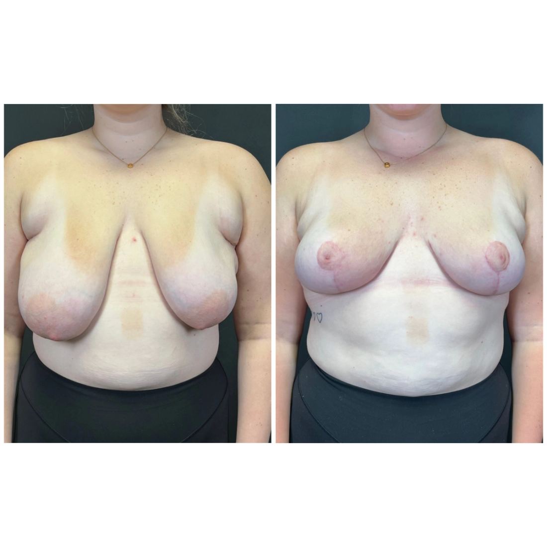 Breast Lift before and after, case breast-lift-new-04