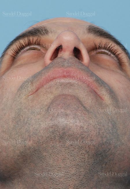 Rhinoplasty after, case 2909