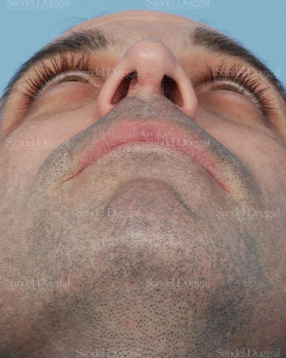 Rhinoplasty after, case 2909