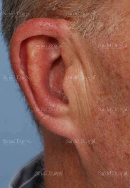 Reconstruction after Mohs after, case 2736