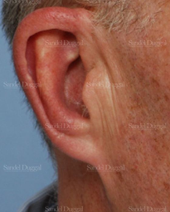 Reconstruction after Mohs after, case 2736