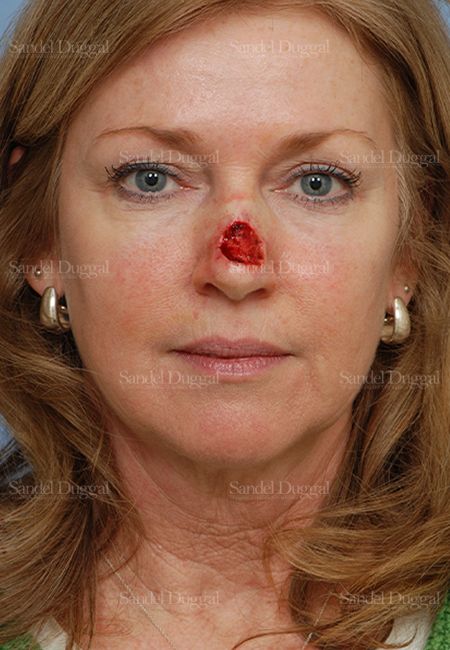 Reconstruction after Mohs before, case 2790