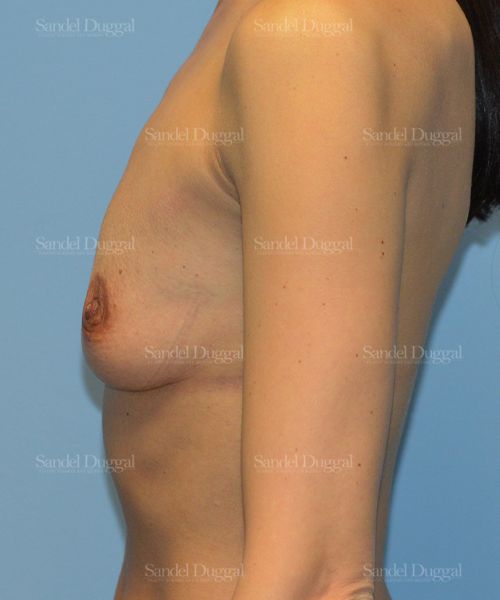 Breast Augmentation before, case 3227