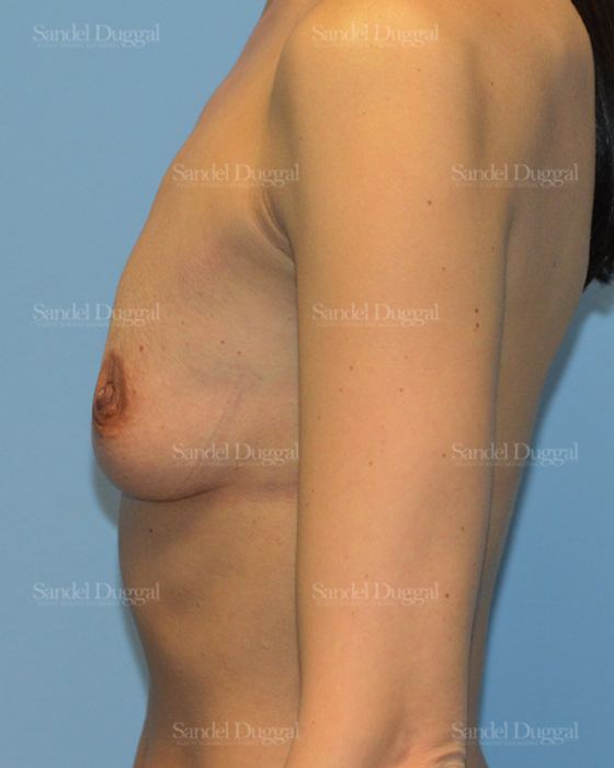 Breast Augmentation before, case 3227