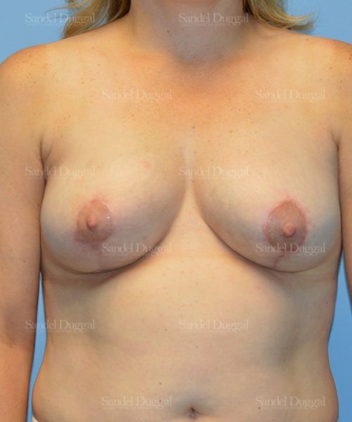 Breast Lift after, case 3294