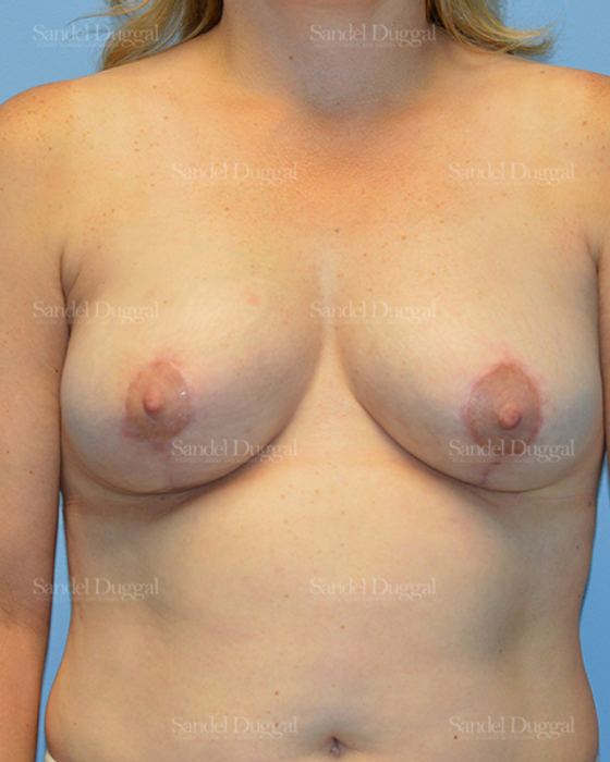 Breast Lift after, case 3294