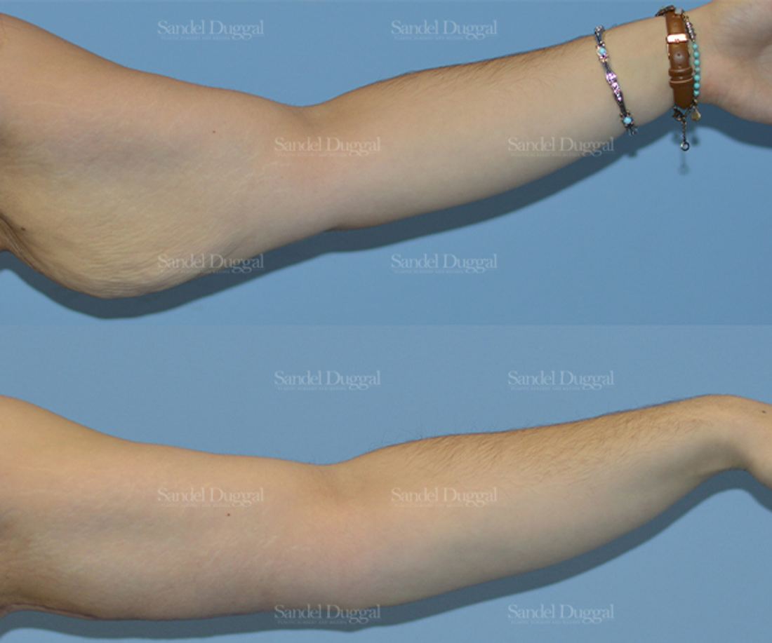 Brachioplasty before and after, case 2156