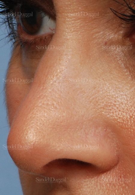 Revision Rhinoplasty after, case 2624