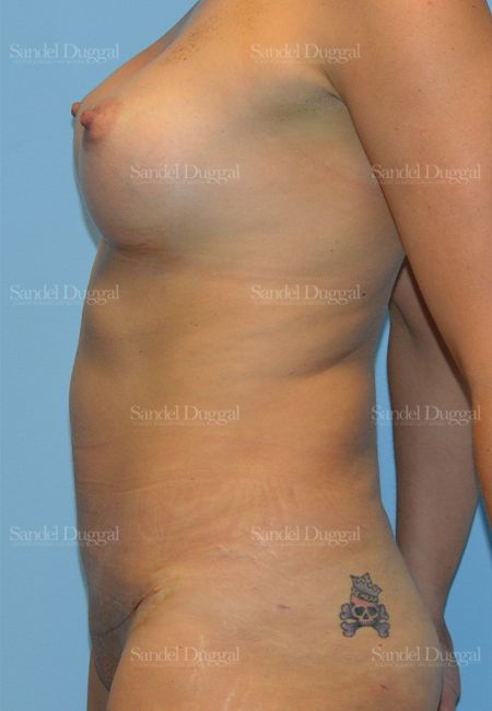 Mommy Makeover after, case 785