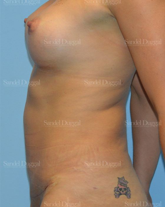 Mommy Makeover after, case 785