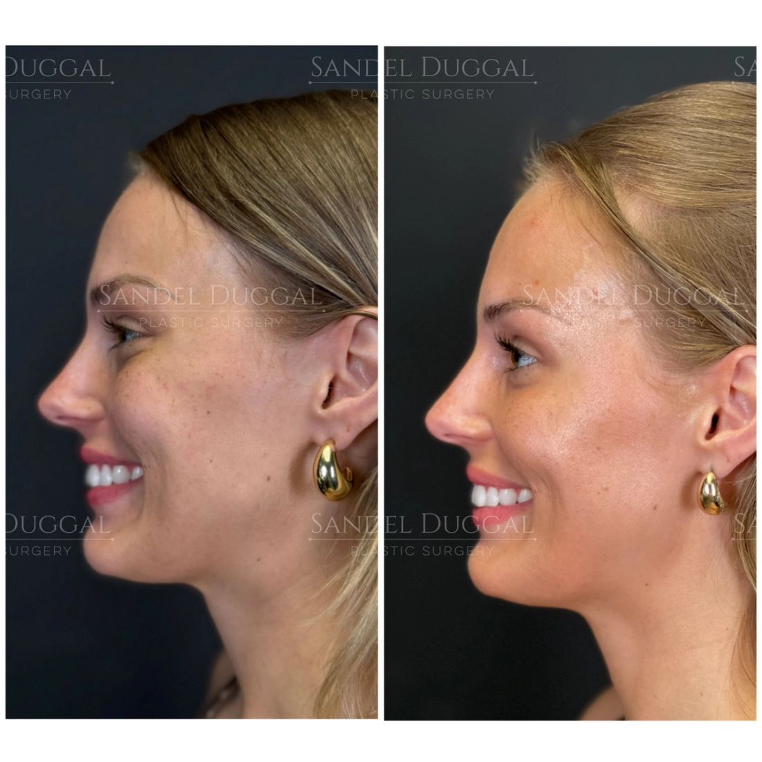 Botox & Fillers before and after, case 6012