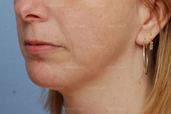 Chin Augmentation after, case 1474