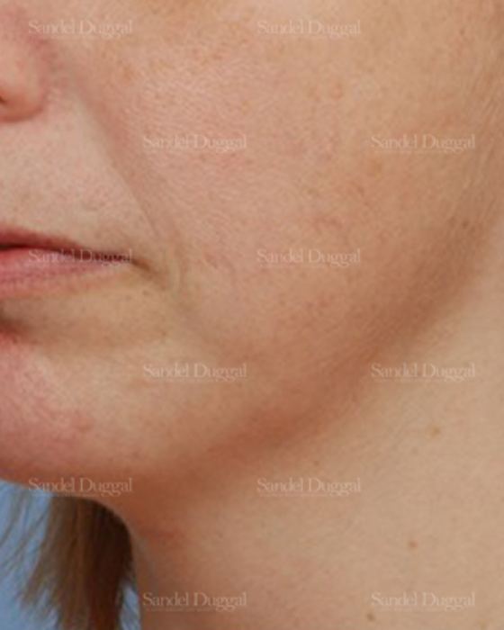 Chin Augmentation after, case 1474