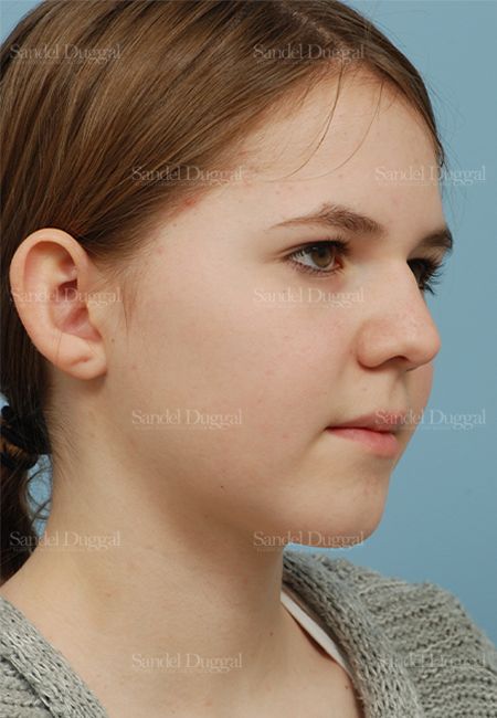 Otoplasty before, case 2598