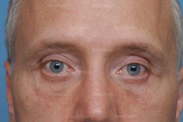Revision Rhinoplasty after, case 2609