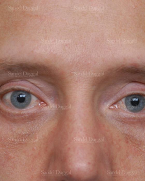 Revision Rhinoplasty after, case 2609