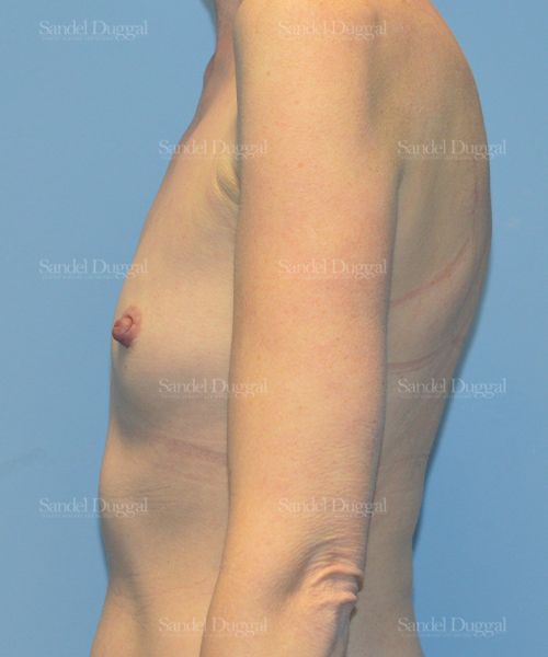 Breast Augmentation before, case 3241