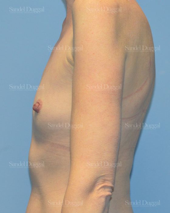 Breast Augmentation before, case 3241