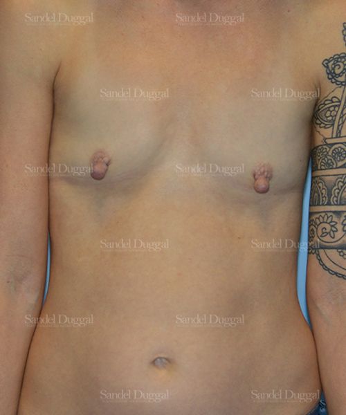 Breast Augmentation before, case 3136