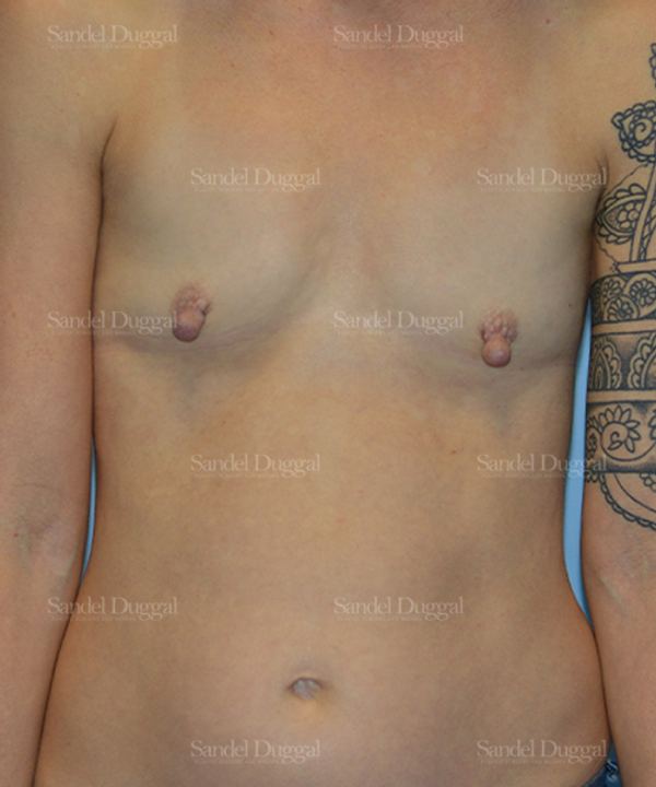 Breast Augmentation before, case 3136