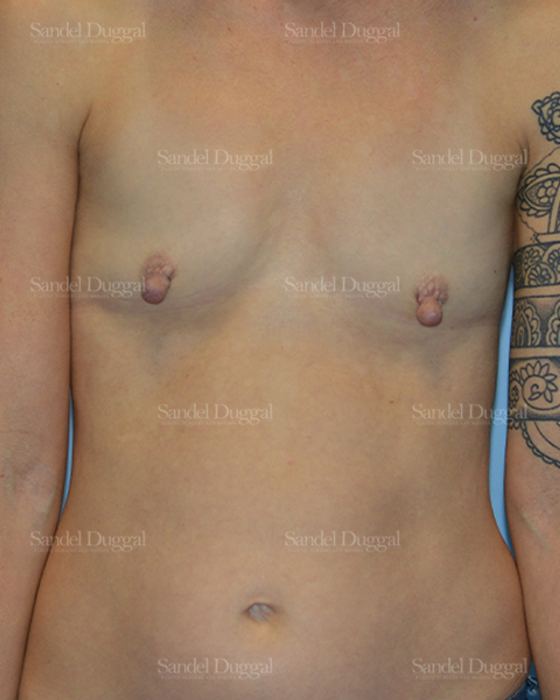 Breast Augmentation before, case 3136