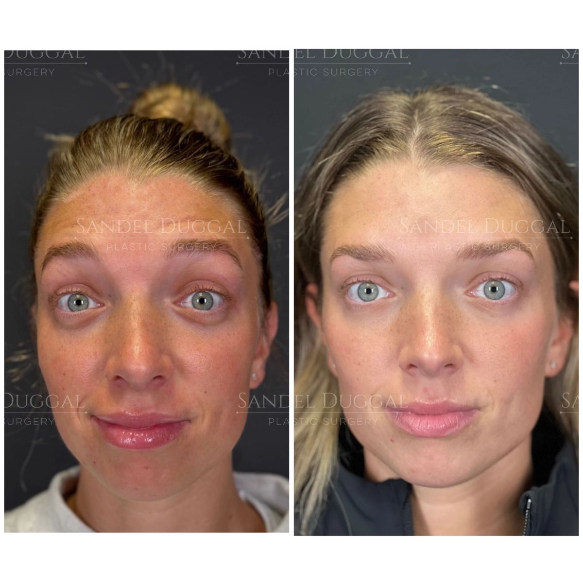 Botox & Fillers before and after, case 6009