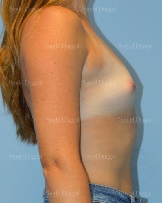 Breast Augmentation before, case 4764