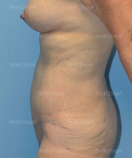 Tummy Tuck after, case 1519
