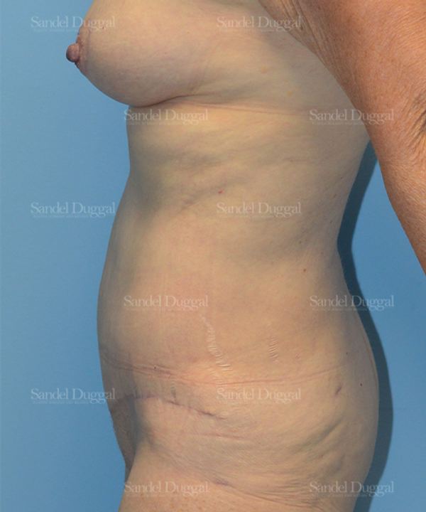 Tummy Tuck after, case 1519