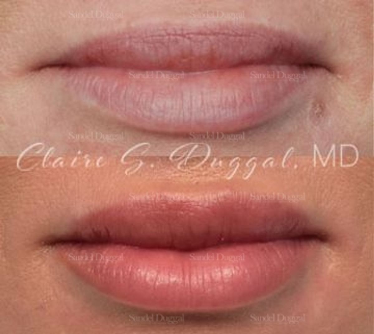 Lip Augmentation / Lip Lift before and after, case 4377