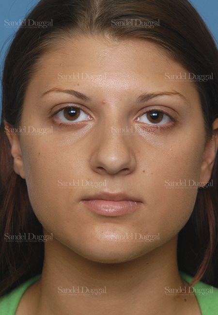 Rhinoplasty before, case 2885