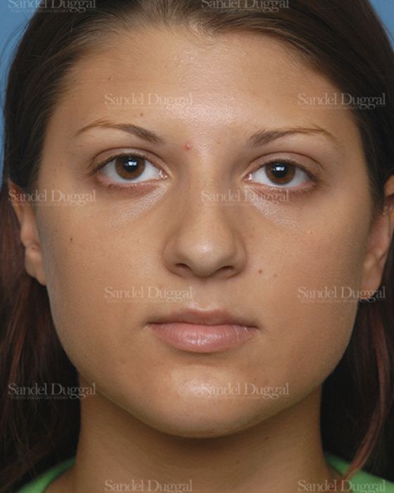 Rhinoplasty before, case 2885