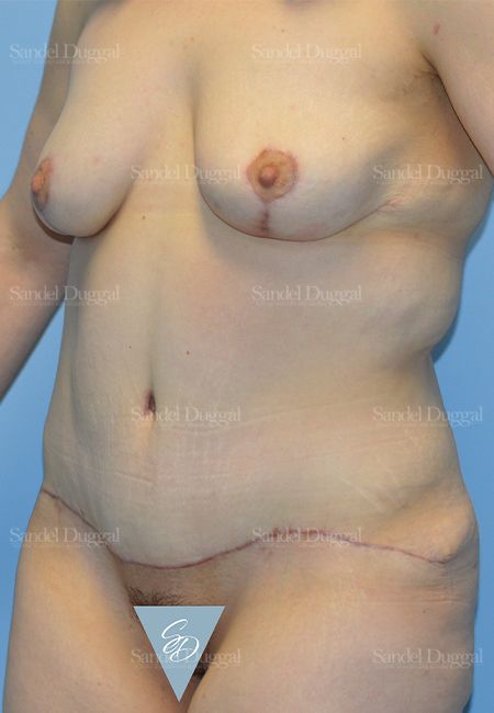 Mommy Makeover after, case 2183