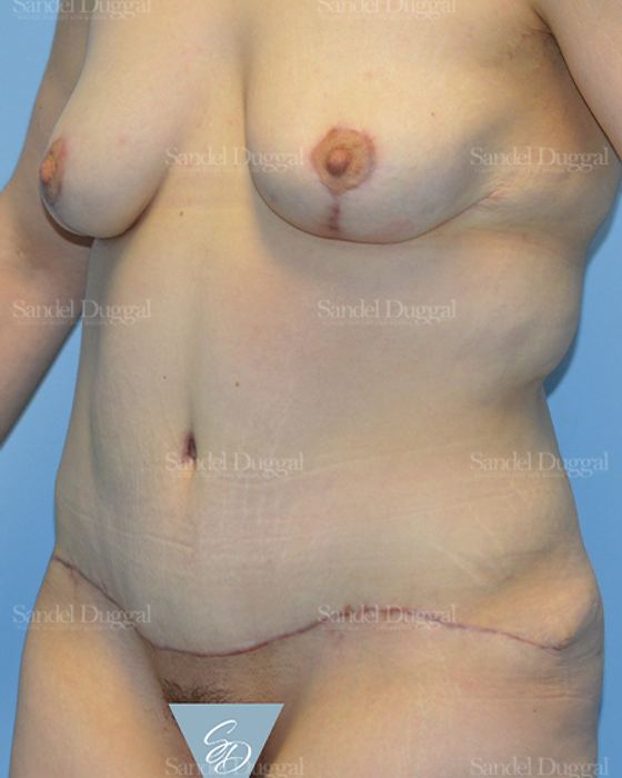 Mommy Makeover after, case 2183