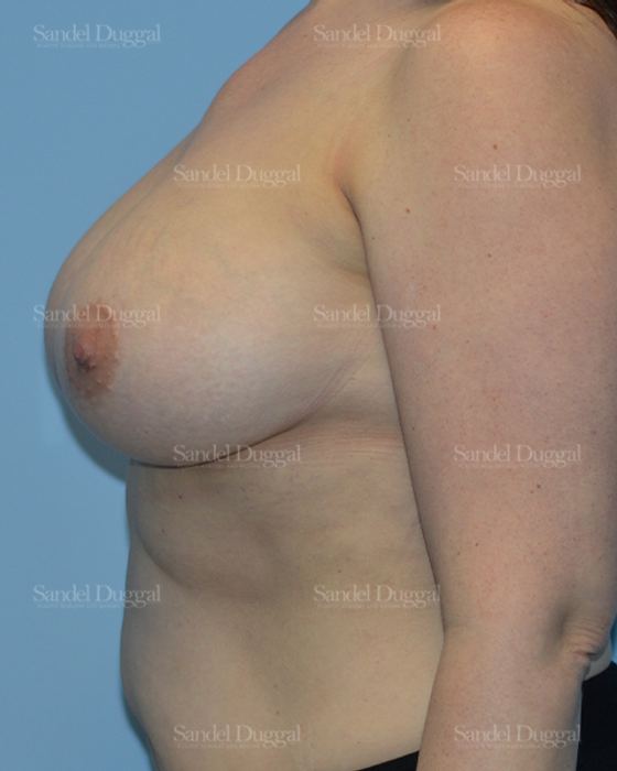 Breast Augmentation after, case 3206