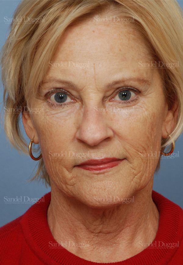 Laser Skin Resurfacing before, case 2958