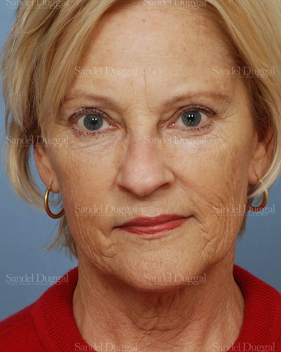 Laser Skin Resurfacing before, case 2958