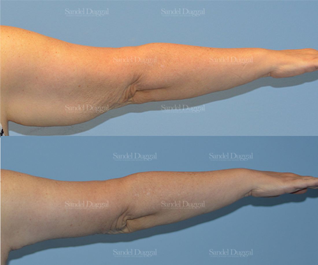 Brachioplasty before and after, case 2108