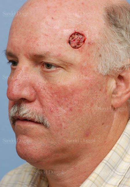 Reconstruction after Mohs before, case 2763