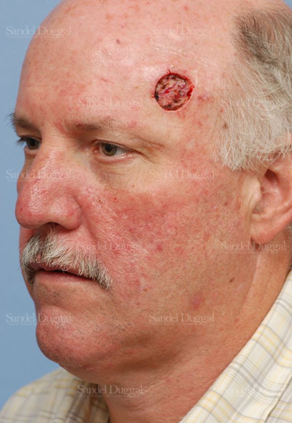 Reconstruction after Mohs before, case 2763