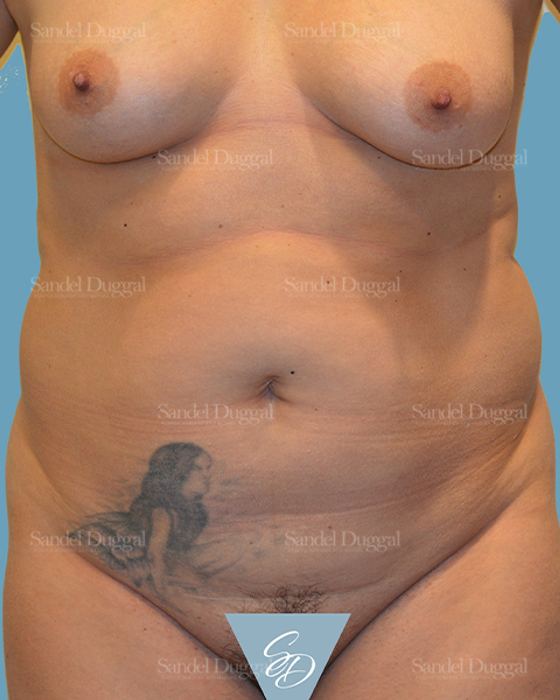 Tummy Tuck before, case 1526