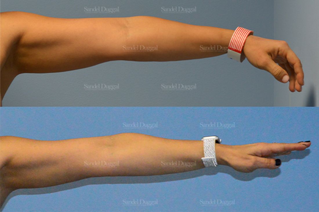 Liposuction — Arms before and after, case 2482