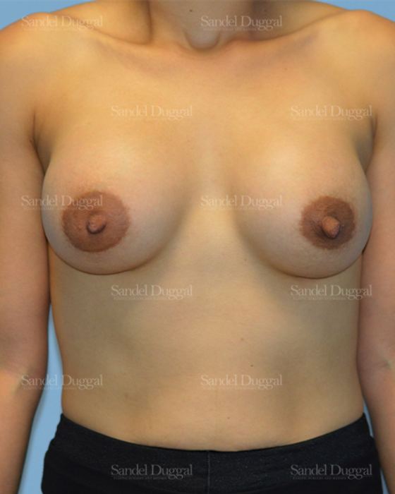 Breast Augmentation after, case 3255
