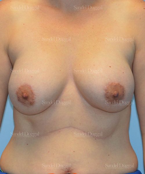 Breast Augmentation with Lift after, case 3456