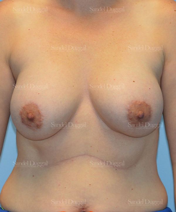 Breast Augmentation with Lift after, case 3456